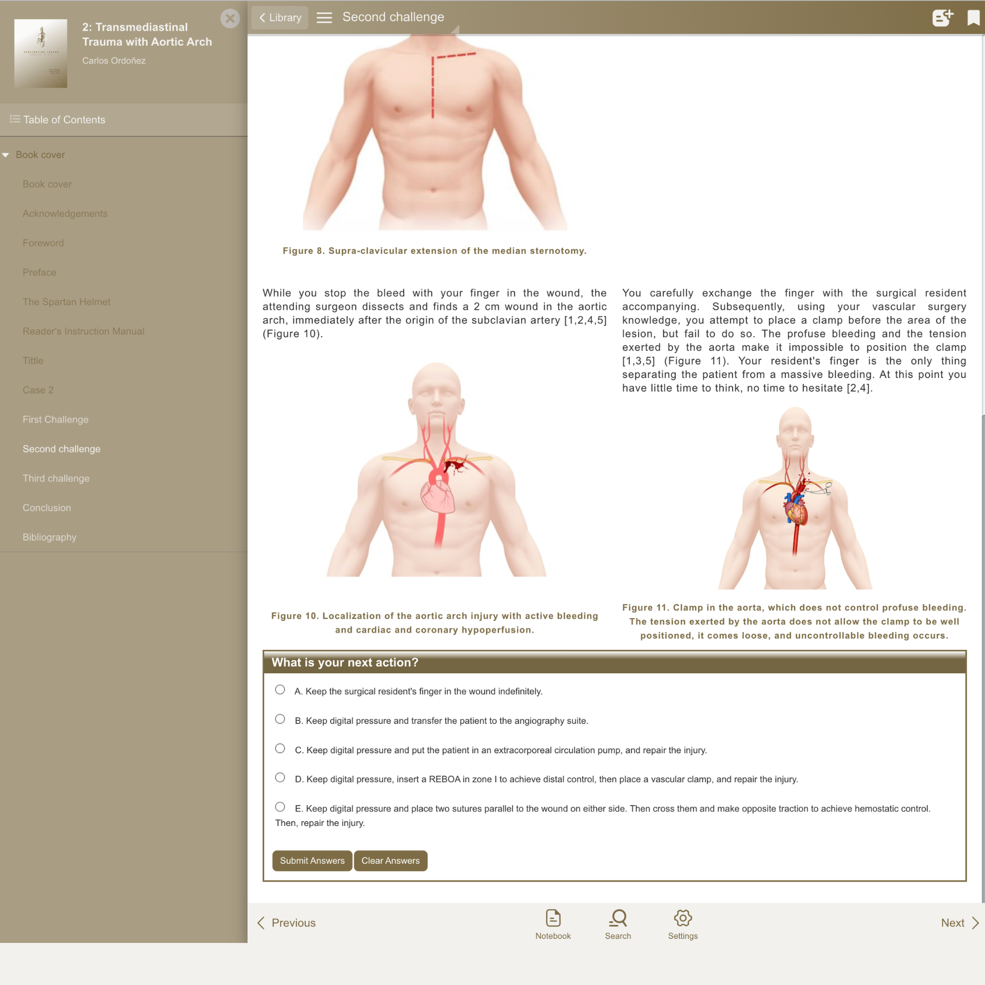 Case 2 (EN): Transmediastinal Trauma with Aortic Arch Injury
