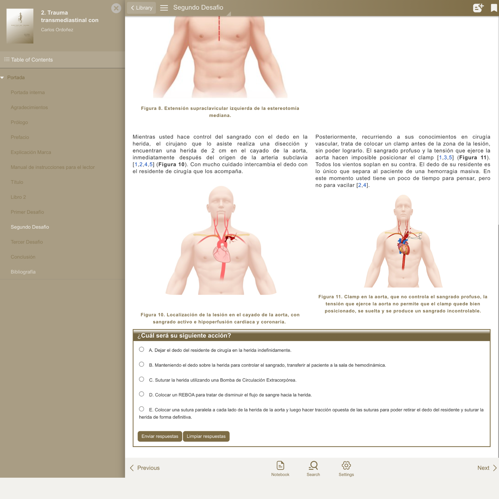 Caso 2 (ES): Trauma transmediastinal con lesión del arco aórtico